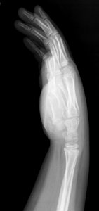X-ray of the hand of an 8 year old male - lateral