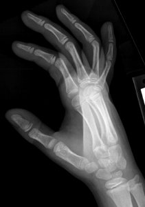 X-ray of the hand of a 9 year old male - oblique