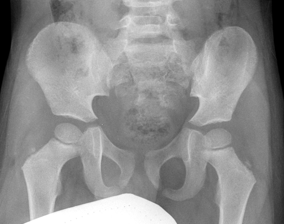 X-ray of the pelvis of a 3 year old male - case 1 - anteroposterior
