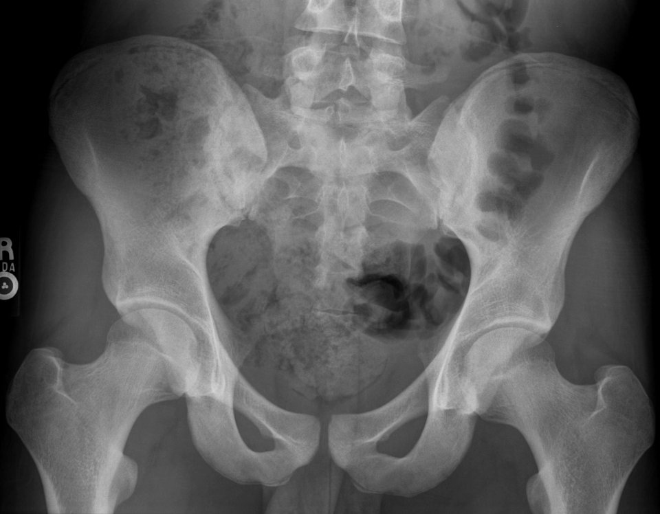 X-ray of the pelvis of an 18 year old male - case 1 - anteroposterior