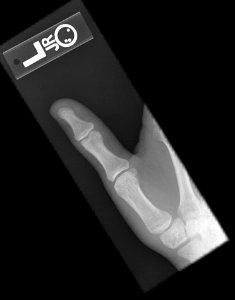 X-ray of the thumb of an 18 year old male - posteroanterior photo