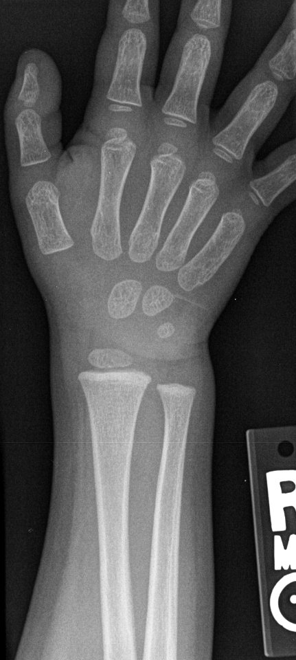 X-ray of the wrist of a 2 year old male - posteroanterior