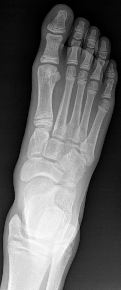 X-ray of a normal foot of a 12 year old male - dorsoplantar