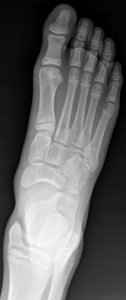 X-ray of a normal foot of a 12 year old male - dorsoplantar photo