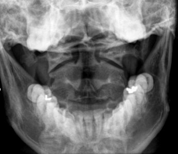 X-ray of the cervical spine of a 20 year old male - odontoid