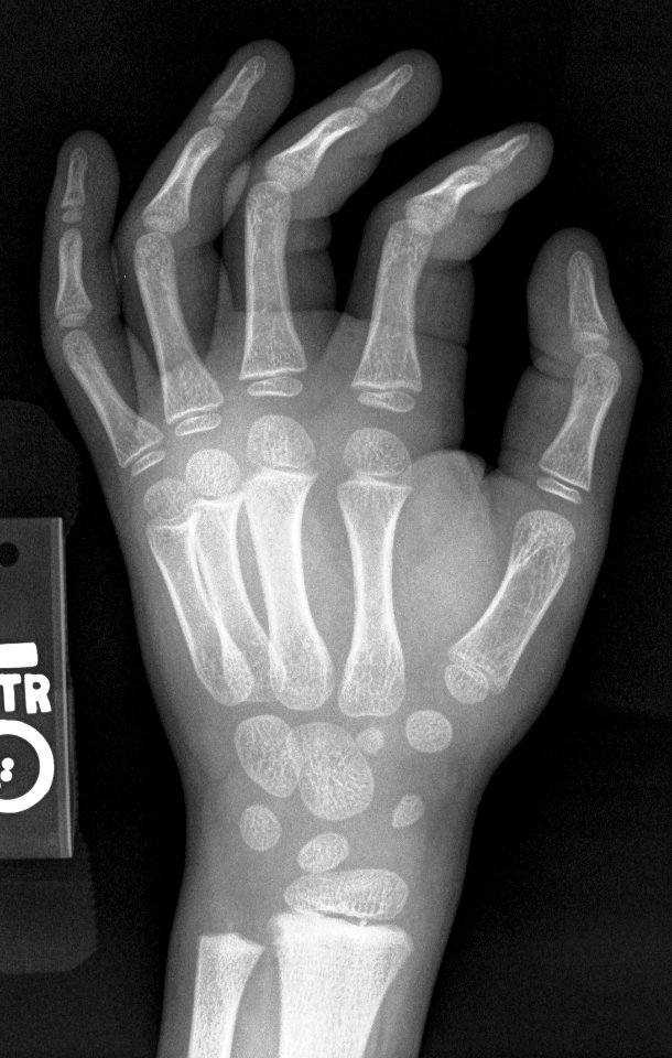 X-ray of the hand of a 5 year old male - case 2 - oblique