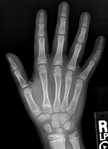X-ray of the hand of a 9 year old male - dorsoplantar