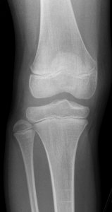 X-ray of the knee of a 9 year old female - case 1 - anteroposterior
