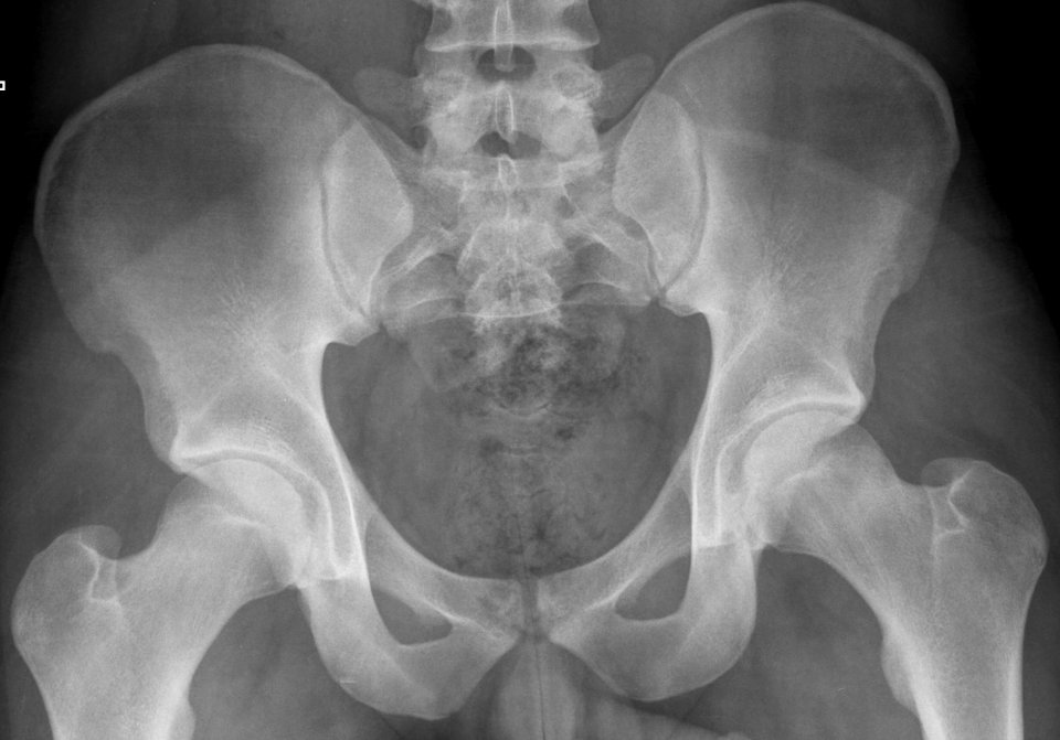 X-ray of the pelvis of an 18 year old male - case 3 - anteroposterior