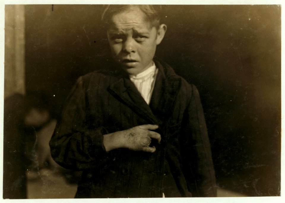 Young cotton mill worker. A piece of the machine fell on his foot mashing his toe. This caused him to fall on to a spinning machine and his hand went into the unprotected gearing, crushing LOC cph.3a21309