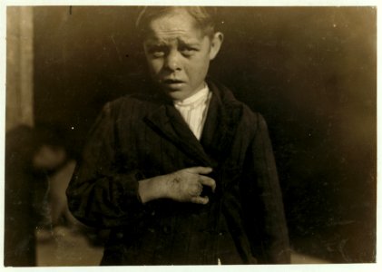 Young cotton mill worker. A piece of the machine fell on his foot mashing his toe. This caused him to fall on to a spinning machine and his hand went into the unprotected gearing, crushing LOC cph.3a21309