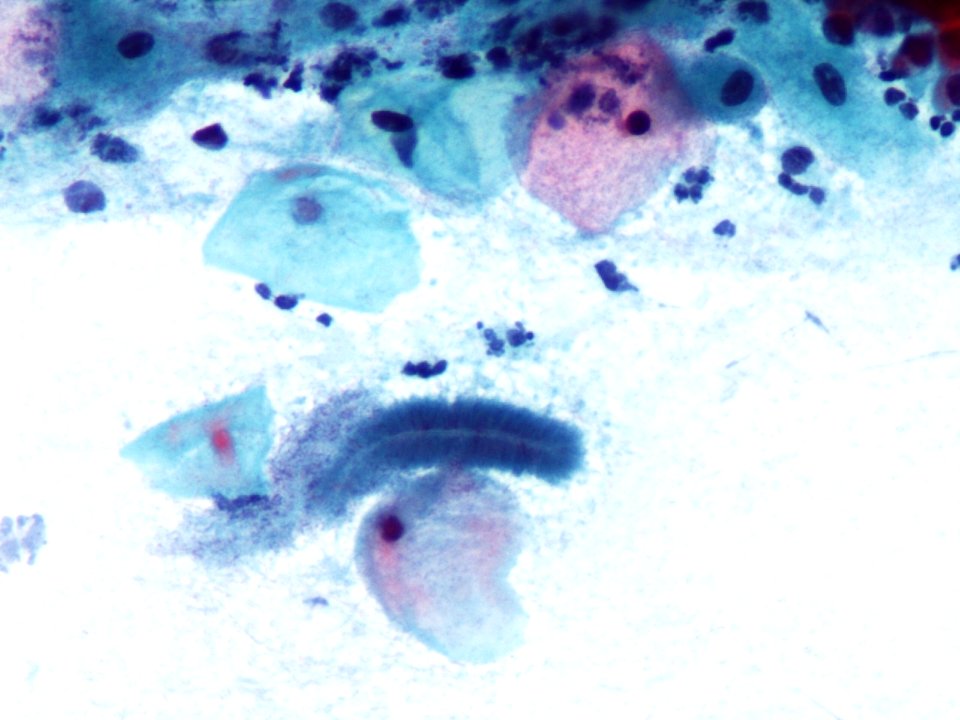 Actinomices (citología de cuello uterino) (9439770879)