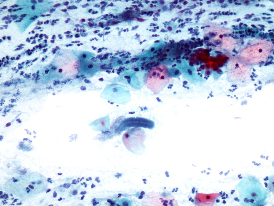 Actinomices (citología de cuello uterino) (9439770787)