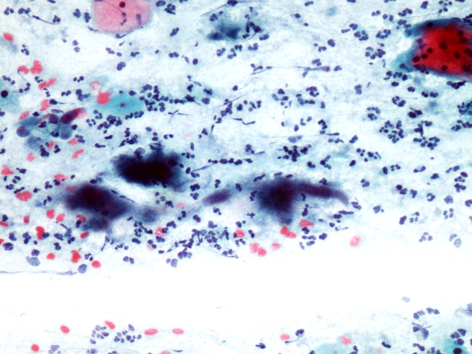 Actinomices (citología de cuello uterino) (9439770653)