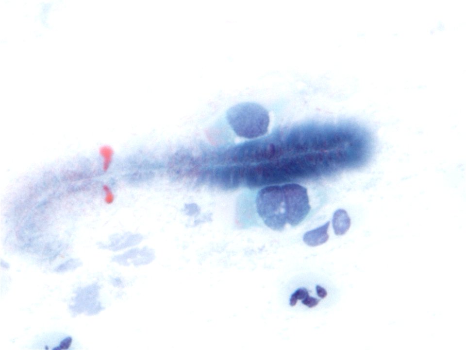 Actinomices (citología de cuello uterino) (9439771045)