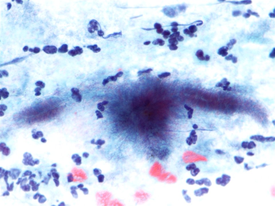 Actinomices (citología de cuello uterino) (9442555752)