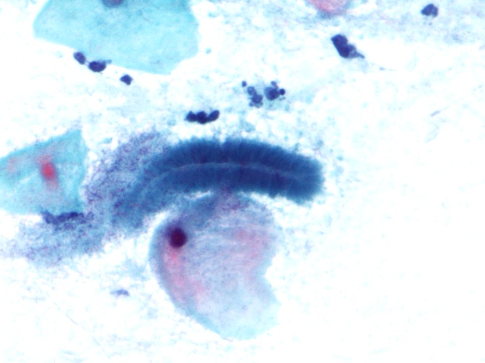 Actinomices (citología de cuello uterino) (9439770885)