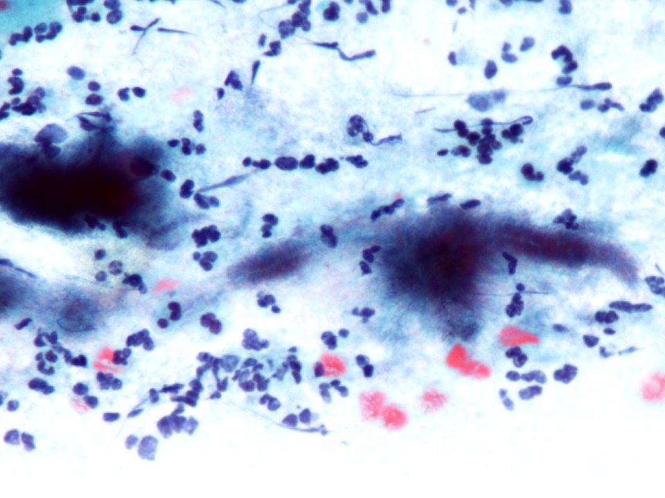 Actinomices (citología de cuello uterino) (9442555742)
