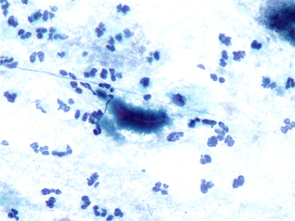 Actinomices (citología de cuello uterino) (9442555744)