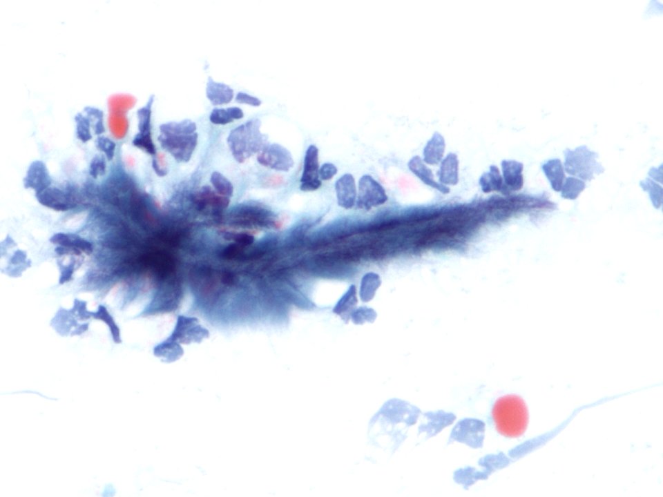 Actinomices (citología de cuello uterino) (9439771101)