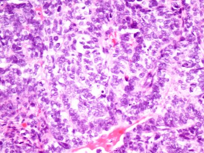 Adenocarcinoma de cuello uterino (9414900133)