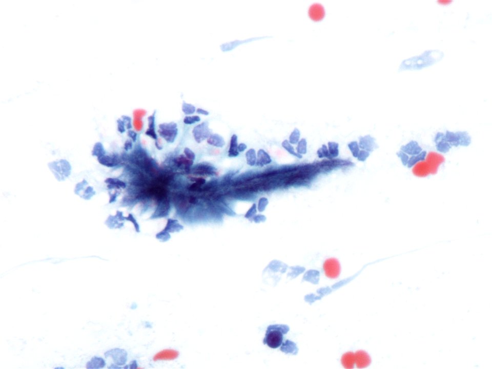 Actinomices (citología de cuello uterino) (9439771055)