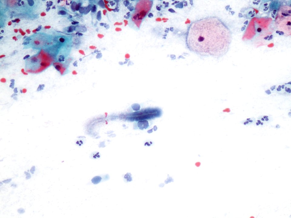 Actinomices (citología de cuello uterino) (9439770975)