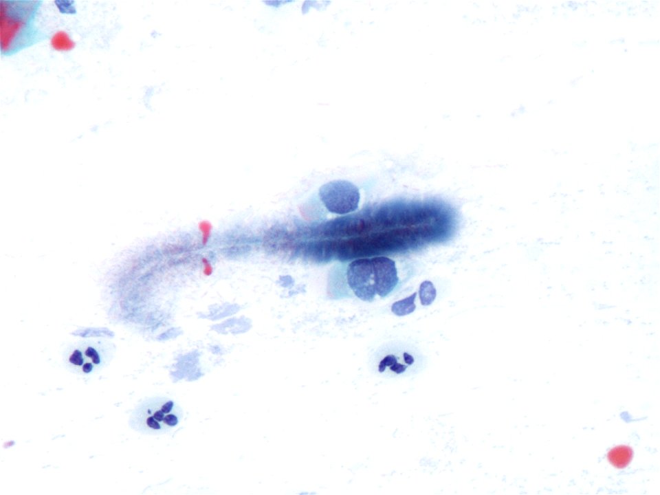Actinomices (citología de cuello uterino) (9442556076)