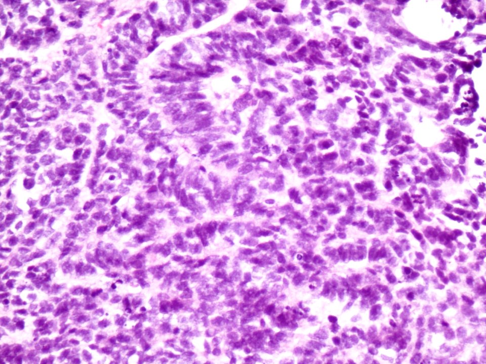 Adenocarcinoma de cuello uterino (9417666718)