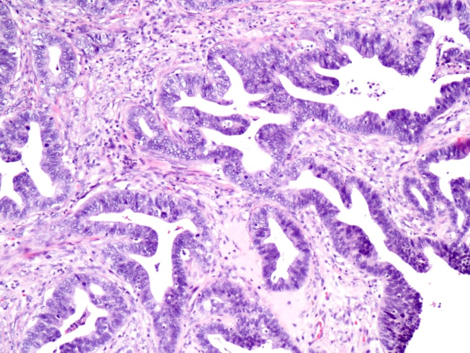 Adenocarcinoma de cuello uterino (9457978321)