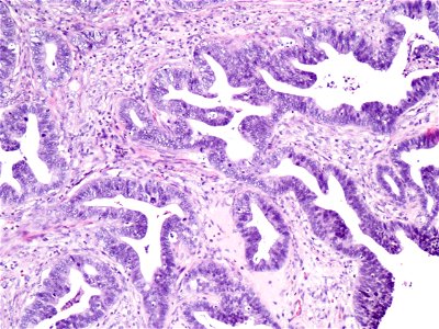 Adenocarcinoma de cuello uterino (9457978321)