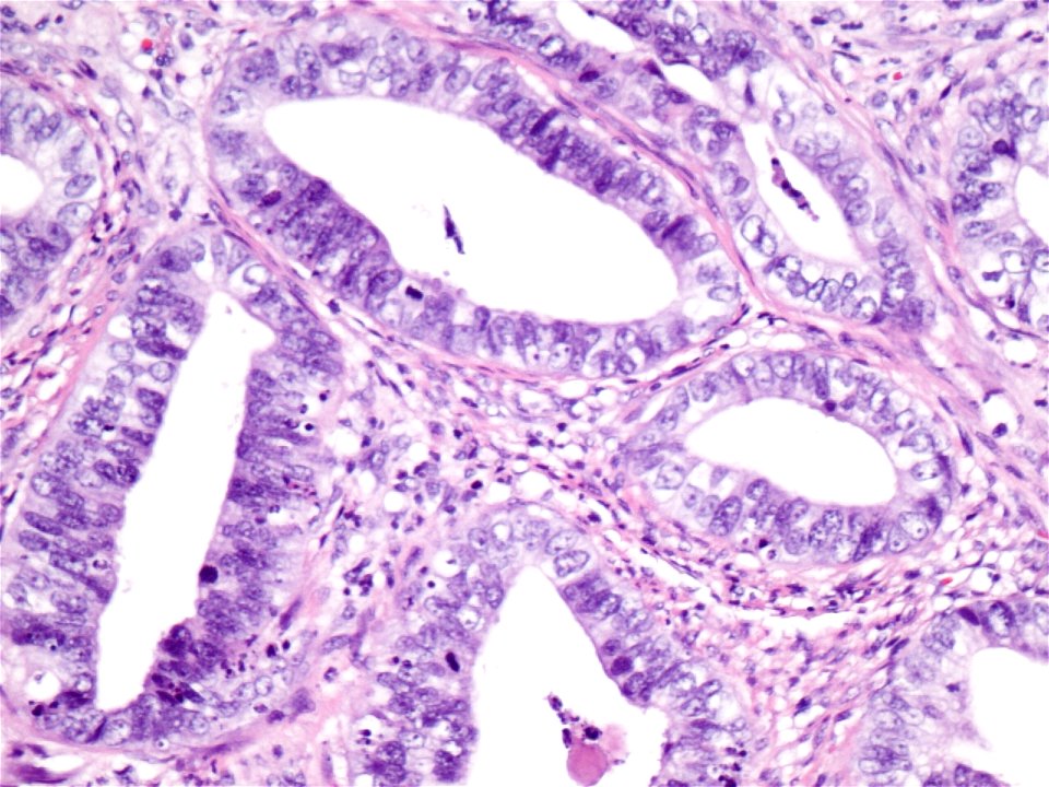 Adenocarcinoma de cuello uterino (9460762086)