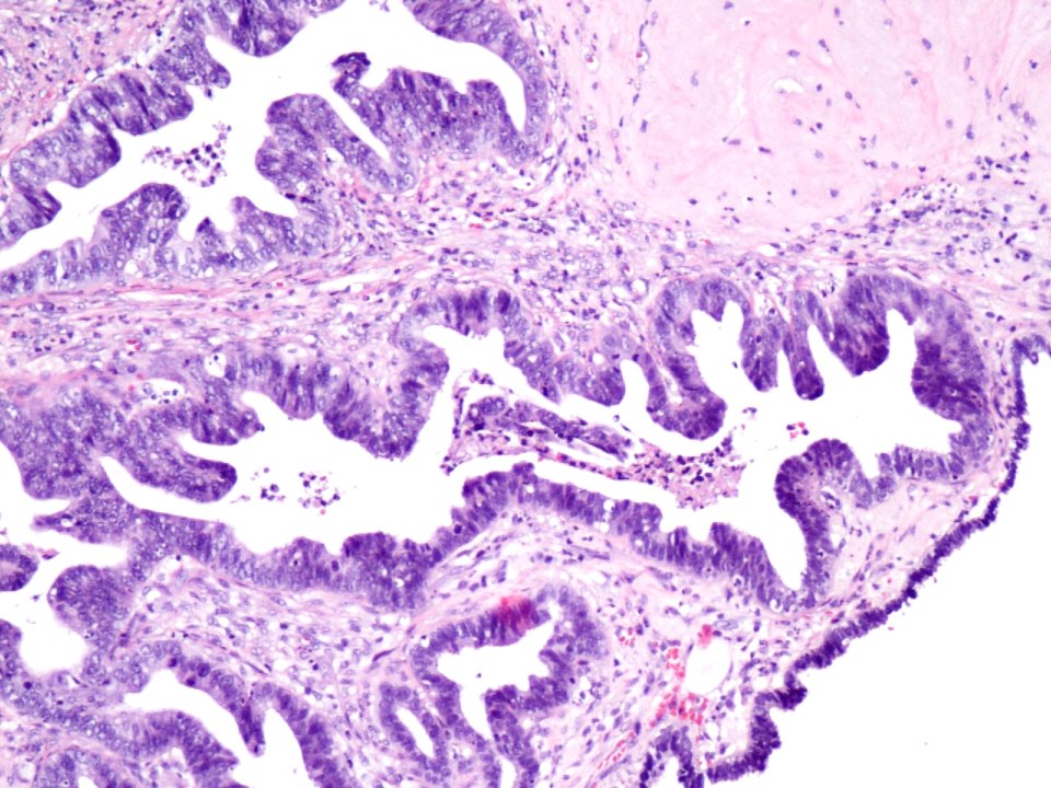 Adenocarcinoma de cuello uterino (9457977777)