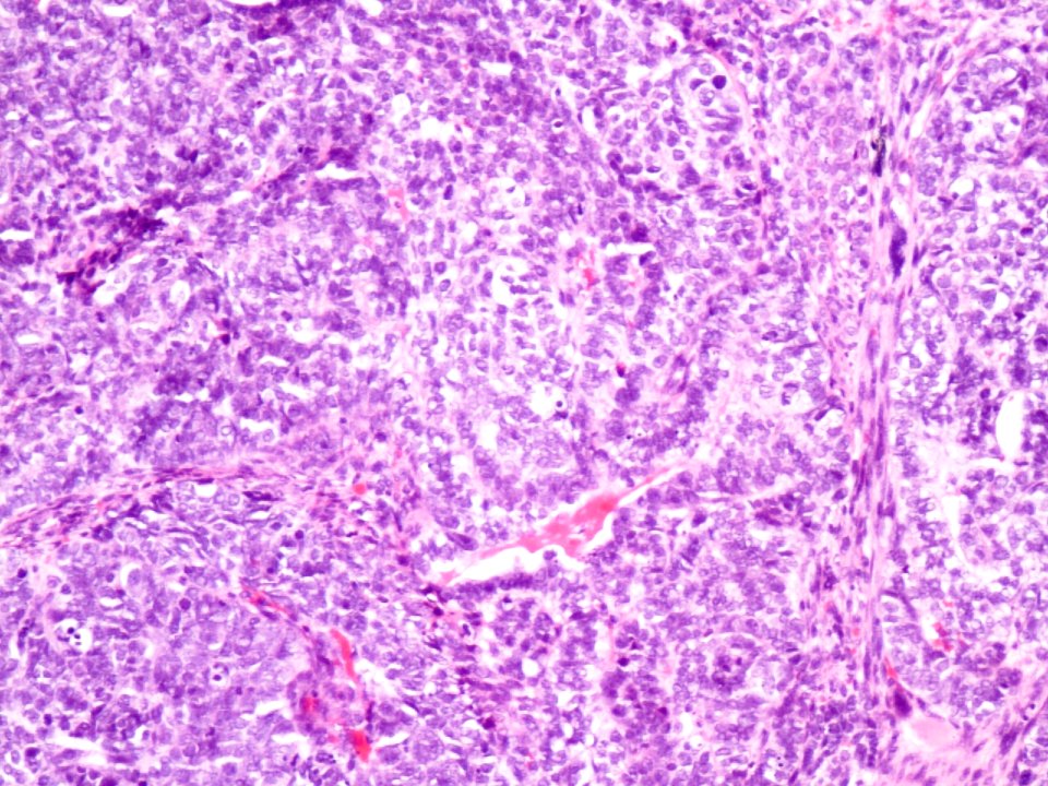 Adenocarcinoma de cuello uterino (9414900131)