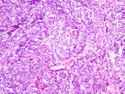 Adenocarcinoma de cuello uterino (9414900131)