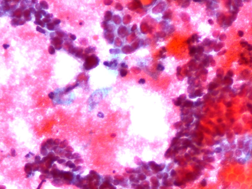 Adenocarcinoma de cuello uterino (9457979665)