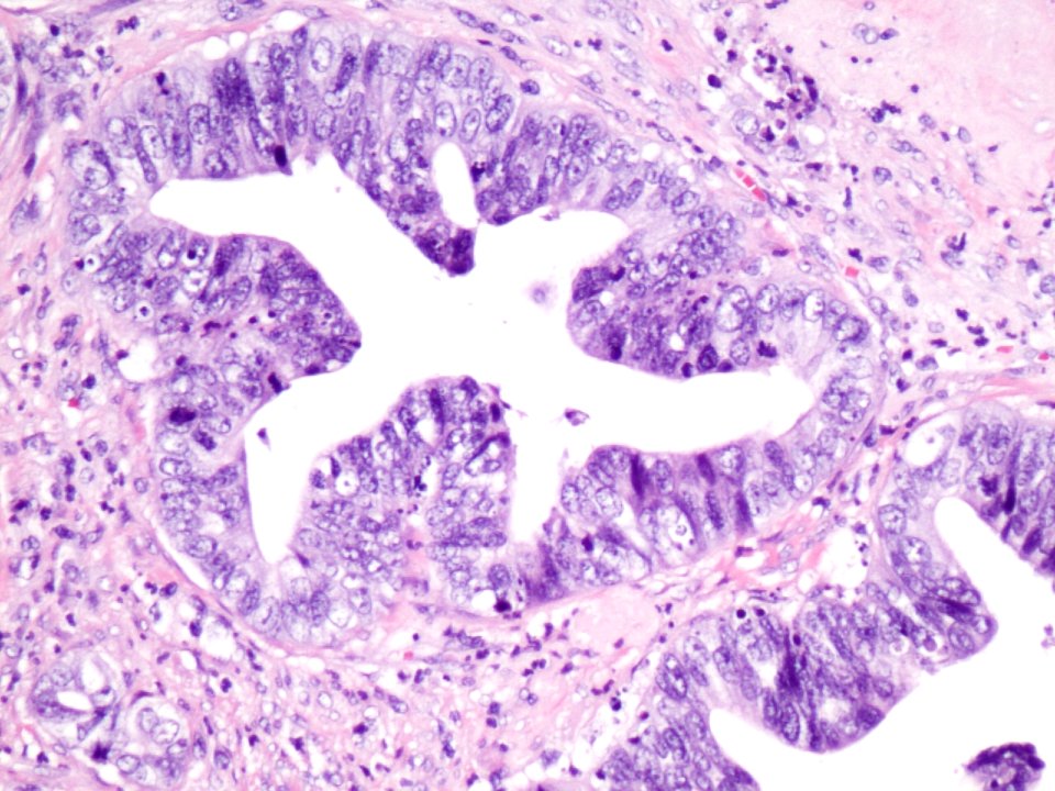 Adenocarcinoma de cuello uterino (9460763628)