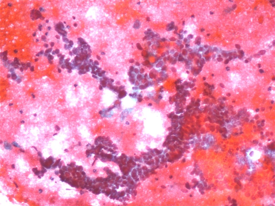 Adenocarcinoma de cuello uterino (9460762460)