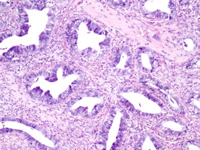Adenocarcinoma de cuello uterino (9460763474)