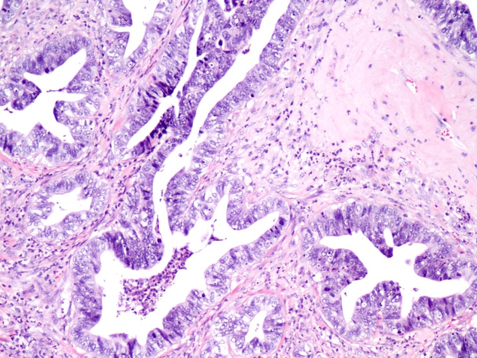 Adenocarcinoma de cuello uterino (9460757690)