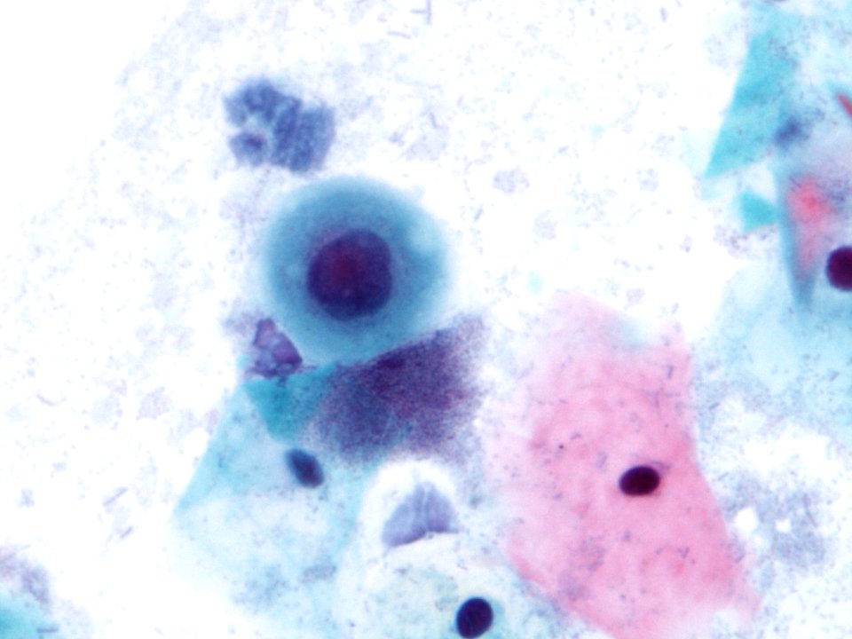 Atipia de células escamosas (ASCUS) (9415351776)