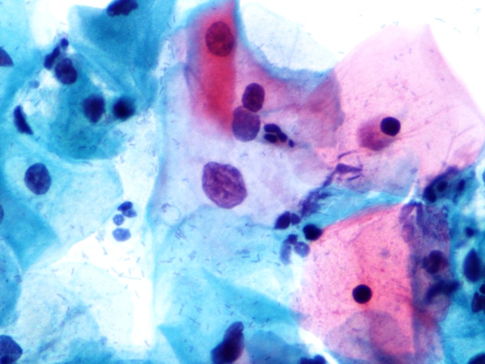 Atipia de células escamosas (ASCUS, ASC) (9392112063)
