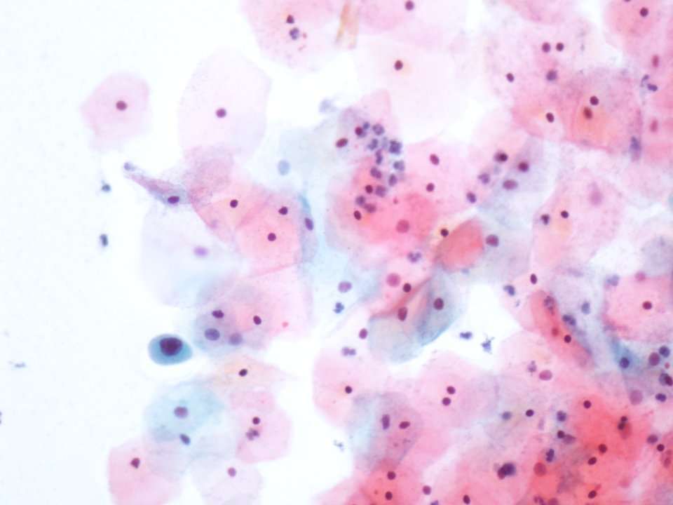 Atipia de células escamosas (ASC, ASCUS) (9292924153)