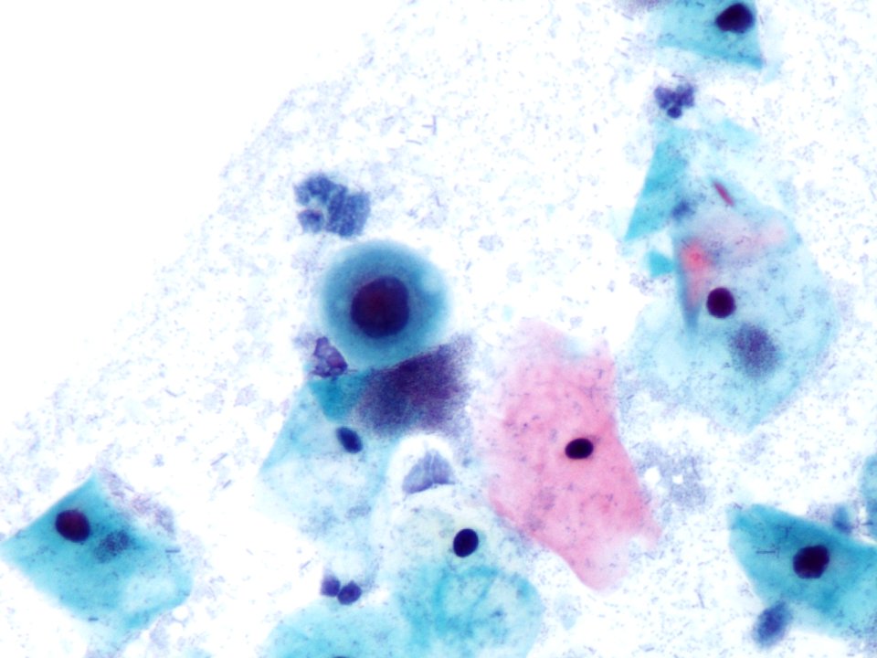 Atipia de células escamosas (ASCUS) (9412585837)
