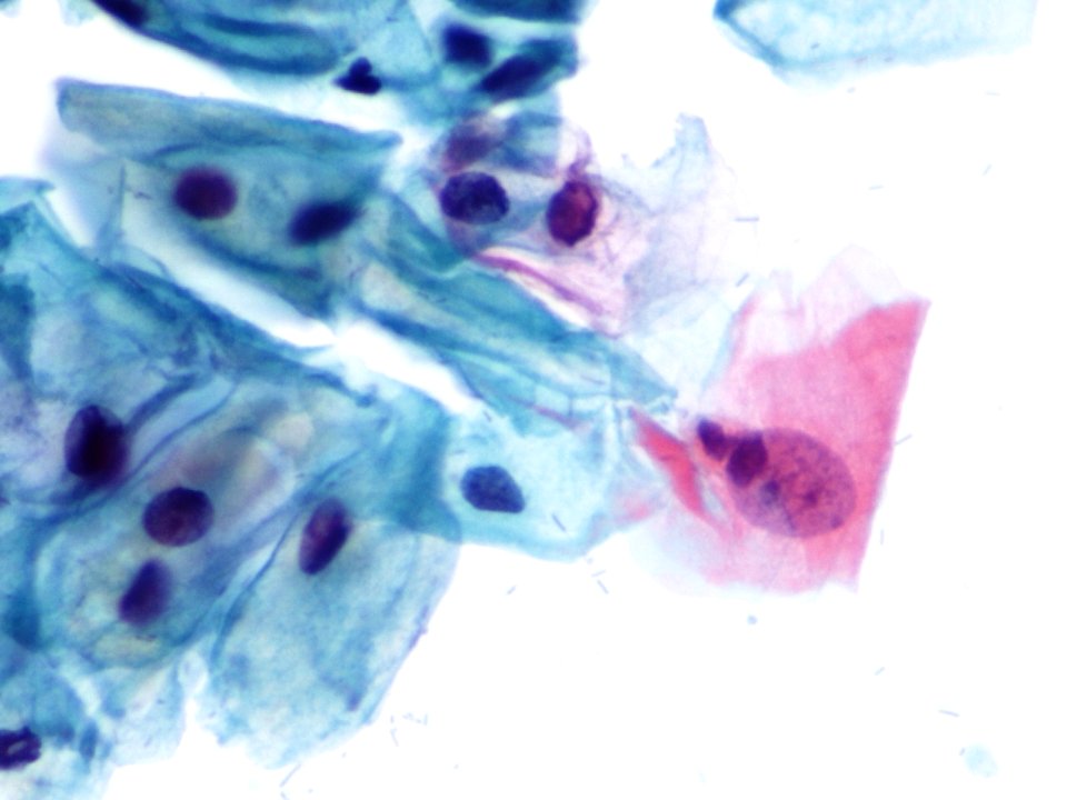 Atipia de células escamosas (ASCUS, ASC) (9392112175)