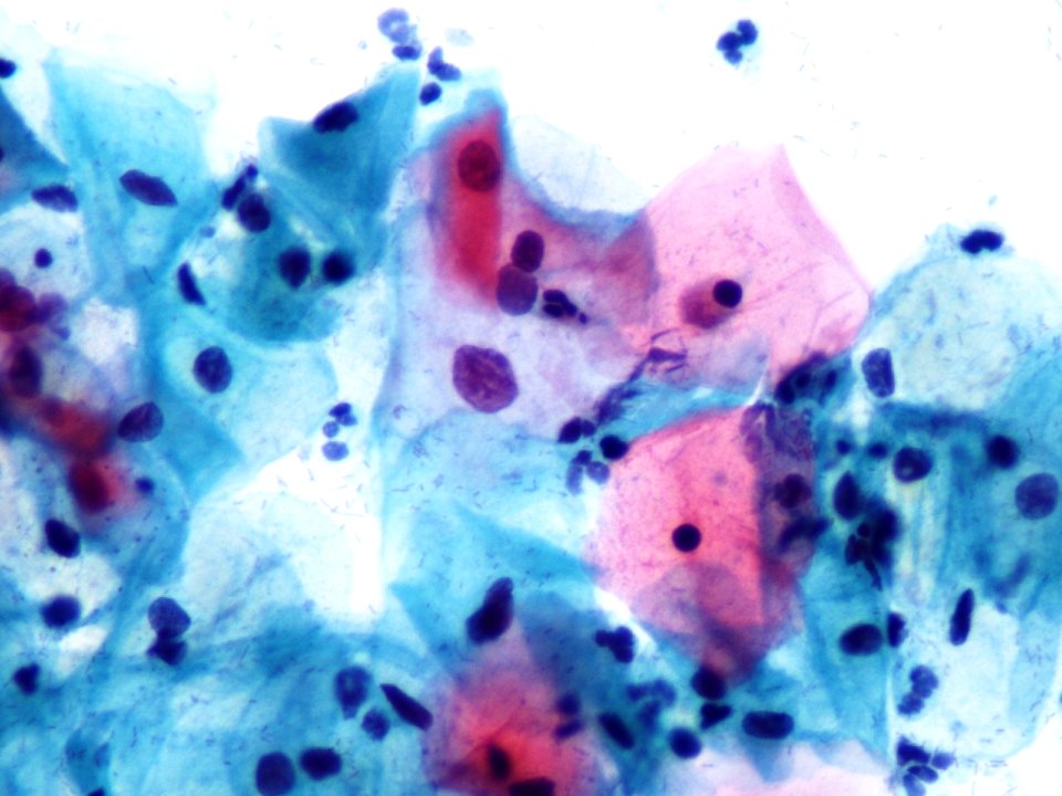 Atipia de células escamosas (ASCUS, ASC) (9394881622)