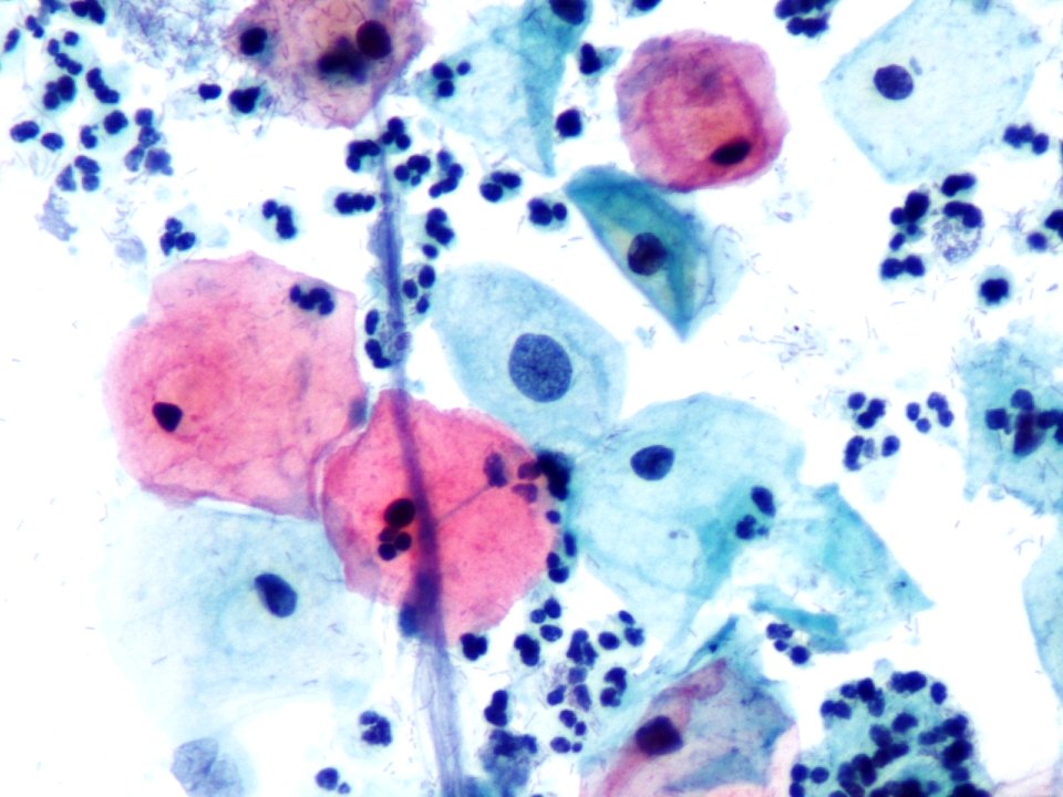 Atipia de células escamosas (ASCUS, ASC) (9394881924)