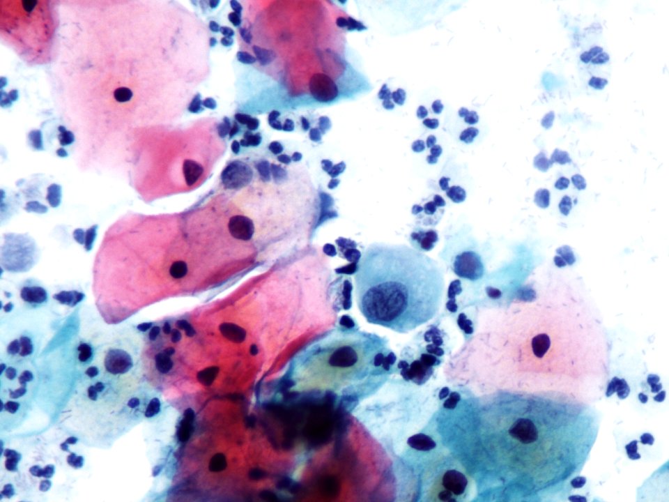 Atipia de células escamosas (ASCUS, ASC) (9392112725)