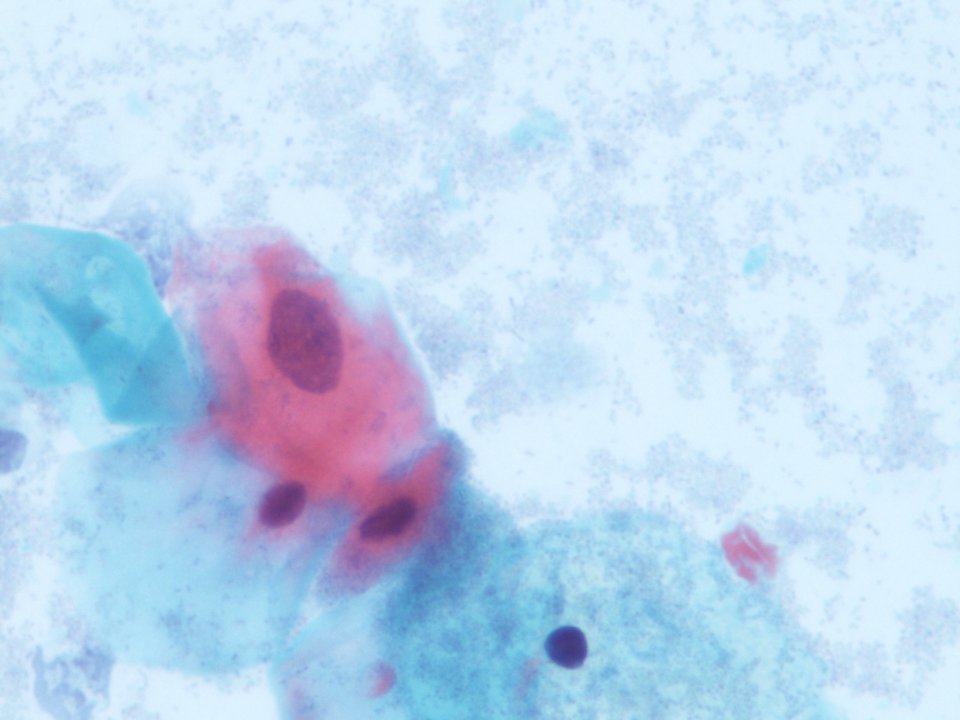 Atipia de células escamosas, probable LSIL, con vaginosis. (9130291917)