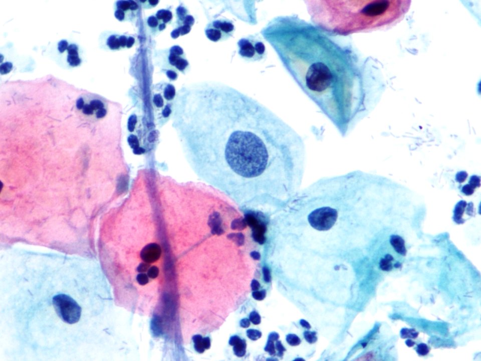 Atipia de células escamosas (ASCUS, ASC) (9392112465)